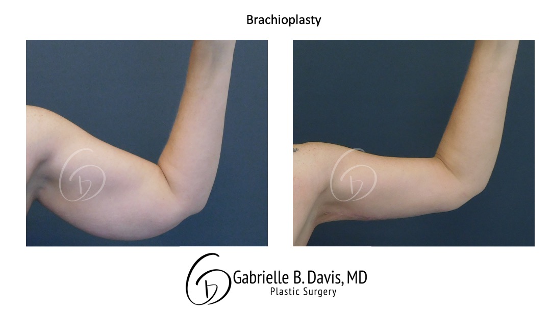 before and after Brachioplasty front view female patient case 2253