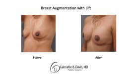 before and after Breast Augmentation + Lift left view female patient case 1592