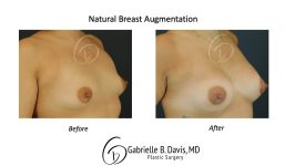 before and after breast augmentation right view female patient case 2369