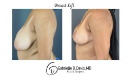 before and after breast lift left side view female patient case 2466