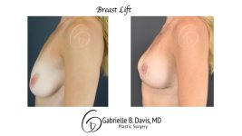 before and after breast lift left side view female patient case 2470