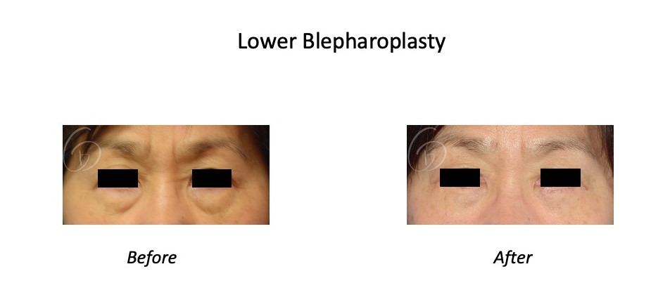 before and after brow lift front view patient GB Davis Plastic Surgery