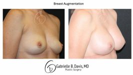 before and after breast augmentation right angle view female patient case 3527