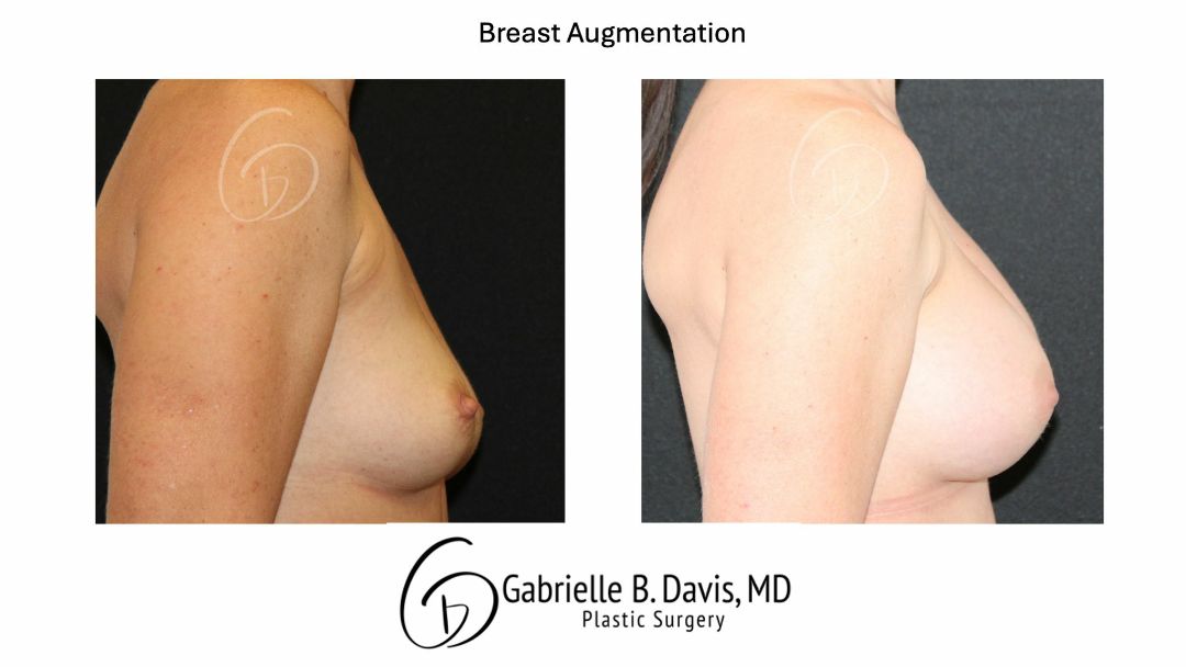 before and after breast augmentation right side view female patient case 3527