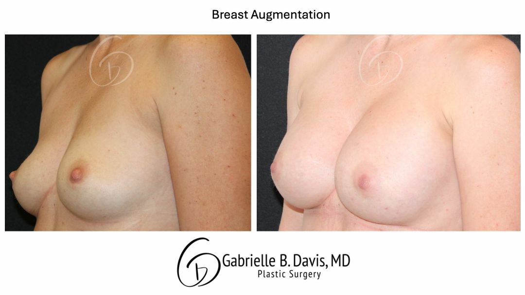 before and after breast augmentation left angle view female patient case 3527