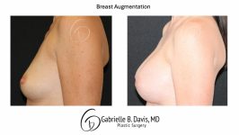 before and after breast augmentation left side view female patient case 3527