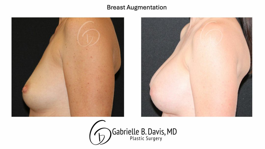 before and after breast augmentation left side view female patient case 3527