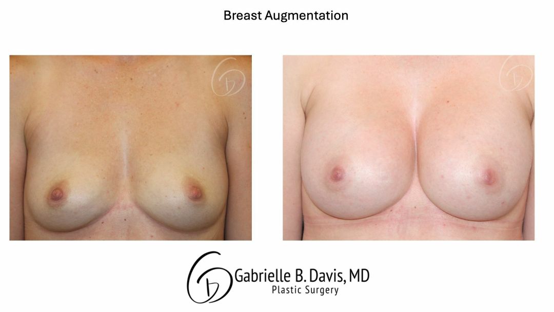 before and after breast augmentation front view female patient case 3527