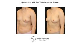 Liposuction with fat transfer to the breast left angle view of female patient 3673