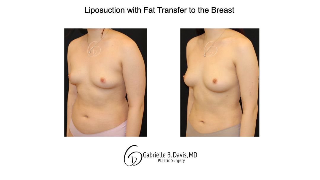 Liposuction with fat transfer to the breast left angle view of female patient 3673