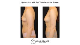 Liposuction with fat transfer to the breast left side view of female patient 3673