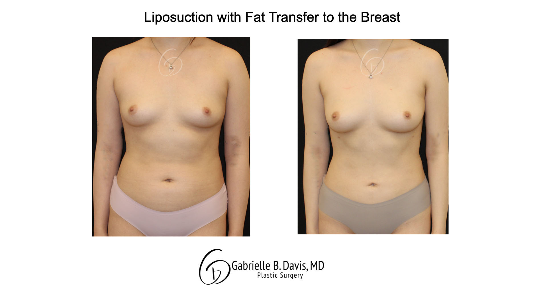 Liposuction with fat transfer to the breast front full view of female patient 3673 no tattoos