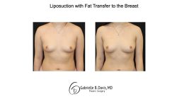 Liposuction with fat transfer to the breast front view of female patient 3673