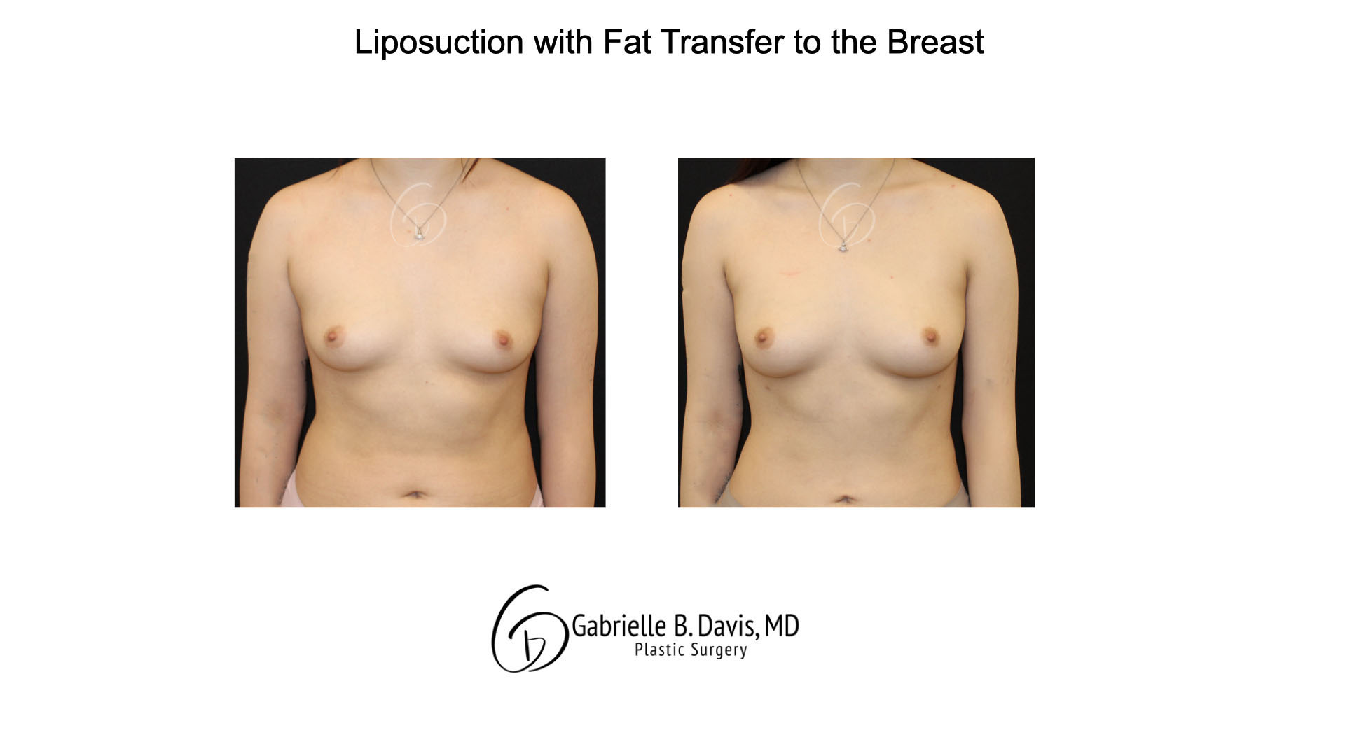 Liposuction with fat transfer to the breast front view of female patient 3673