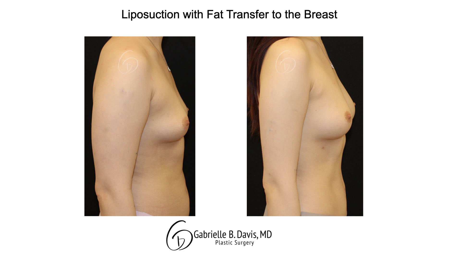 Liposuction with fat transfer to the breast right side view of female patient 3673