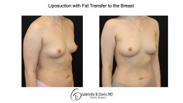 Liposuction with fat transfer to the breast right angle view of female patient 3673