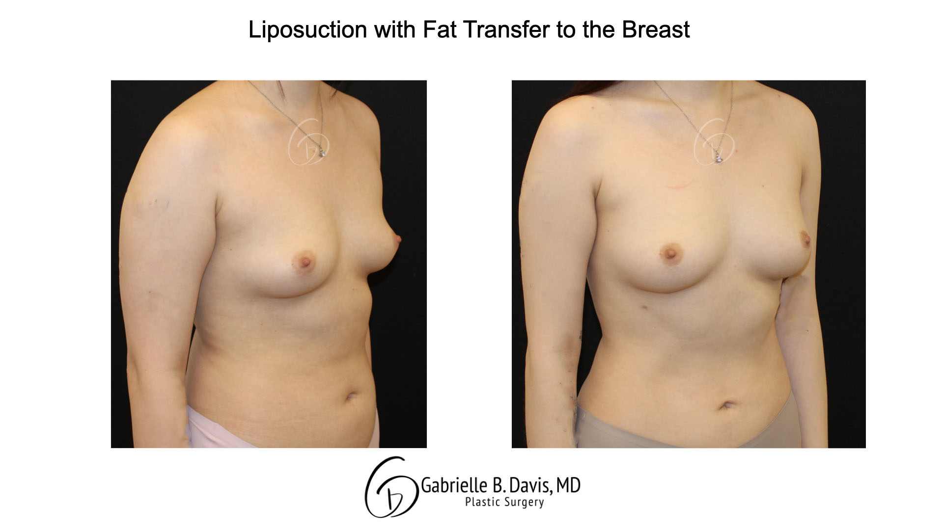 Liposuction with fat transfer to the breast right angle view of female patient 3673